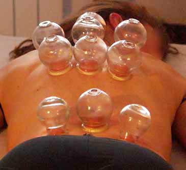 Cupping Thérapie Royan - Lionel Rigour